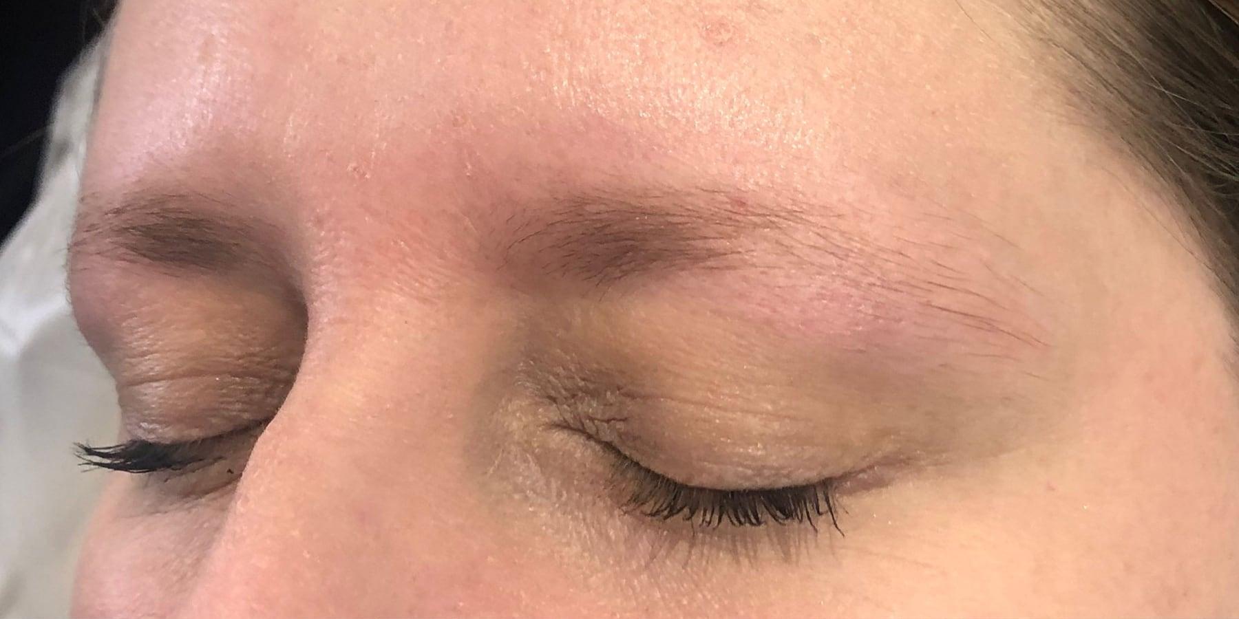 Before the treatment