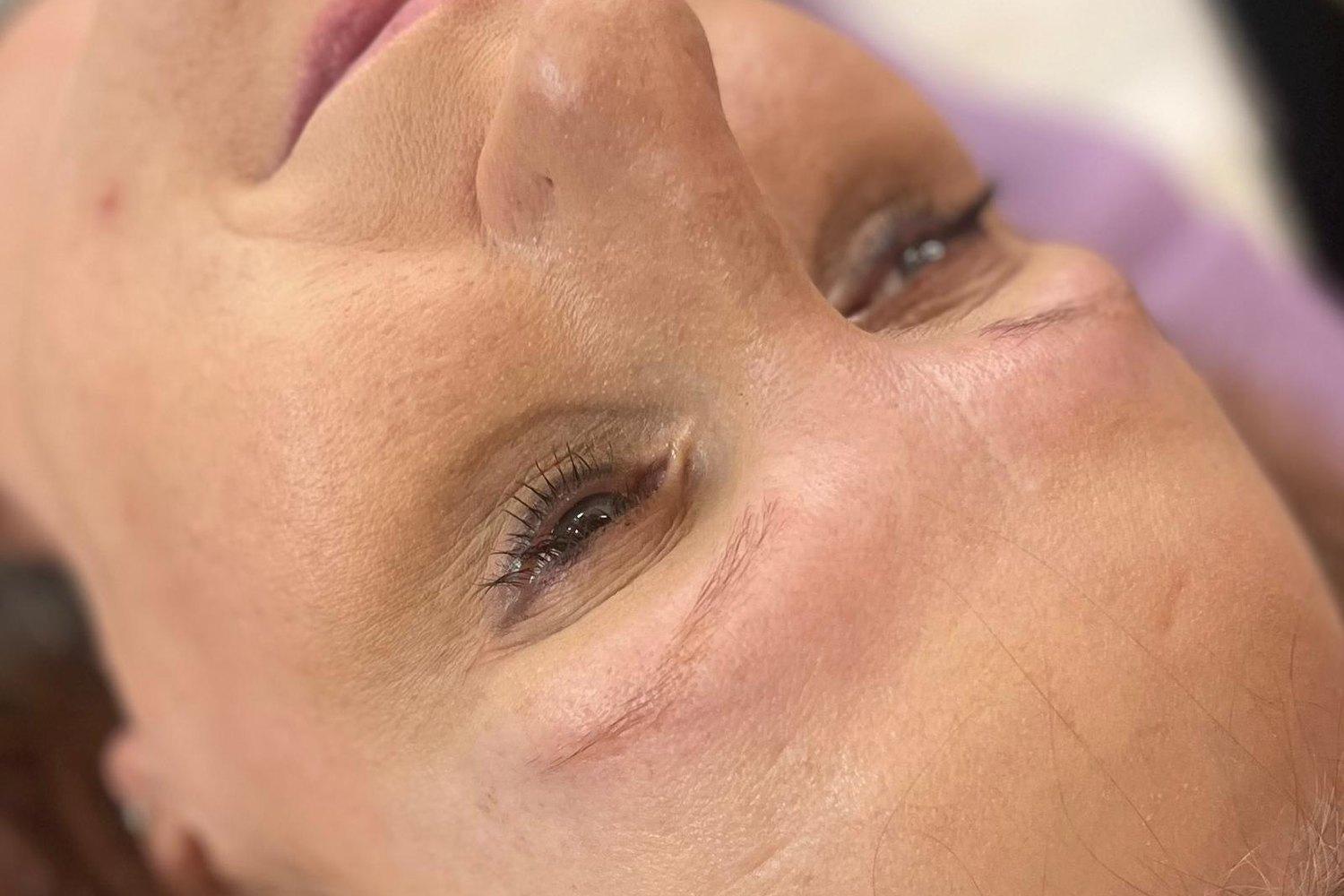 Before the treatment